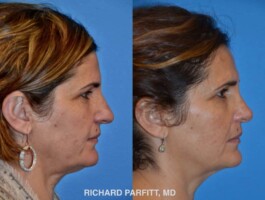 <strong>Procedures: Rhinoplasty and Submental Liposuction</strong> Rhinoplasty and Submental Liposuction by Dr. Parfitt