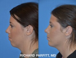 <strong>Procedure: </strong>Rhinoplasty (Nose Job) & Chin Implant Before and After Rhinoplasty, Nose Surgery, Chin implant, plastic surgery by Dr. Parfitt Middleton WI patient-side view