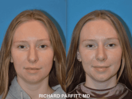<strong>Procedure: Rhinoplasty -reduces hump</strong> Rhinoplasty with Dr. Parfitt Front view reduces hump