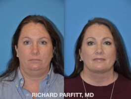 Procedure: Submental Liposuction (chin fat removal) Before and After Submental Liposuction, chin fat removal, after age 50 by Dr. Richard Parfitt, Madison WI