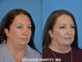 Procedure: Submental Liposuction (chin fat removal) Before and After Submental Liposuction, chin fat removal, after age 50 by Dr. Richard Parfitt, Madison WI - oblique