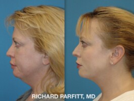 Procedure: Submental Liposuction (chin fat removal) Before and After Submental Liposuction, chin fat removal, by Dr. Richard Parfitt, Madison WI, left side view