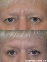 <strong>Procedures: </strong> Upper & Lower Blepharoplasty (Eyelid Surgery) Upper and Lower blepharoplasty, eyelid surgery, Dr. Richard Parfitt patient