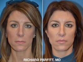 <strong>Procedure:</strong>Upper Lip Lift Upper Lift Lift Madison WI Dr. Parfitt
