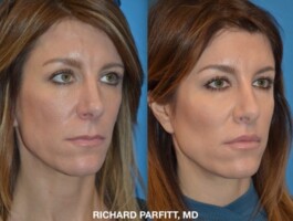 <strong>Procedure:</strong>Upper Lip Lift Upper Lift Lift Madison WI Oblique Dr. Parfitt