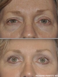 <strong>Procedures: Forehead/Brow Lift; Upper Blepharoplasty; Lower Blepharoplasty</strong> Procedures: Forehead/Brow Lift; Upper Blepharoplasty; Lower Blepharoplasty