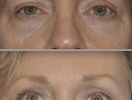 <strong>Procedures: Forehead/Brow Lift; Upper Blepharoplasty; Lower Blepharoplasty</strong> Procedures: Forehead/Brow Lift; Upper Blepharoplasty; Lower Blepharoplasty