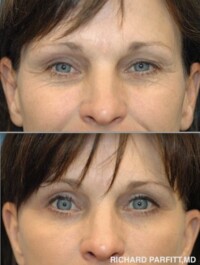 <strong>Procedures: Upper and Lower Blepharoplasty</strong> Upper and Lower Eyelid Rejuvenation - Blepharoplasty with Dr. Parfitt