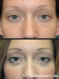 <strong>Procedures: Lower Blepharoplasty - Fat Removal (Bags)</strong> Small amount of fat removed from lower eyelids to reduce the tired look of eye bags