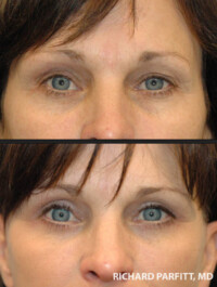 <strong>Procedure: Upper & Lower Blepharoplasty</strong> Upper eyelid tightening and minor lower eyelid tightening surgery by Dr. Parfitt