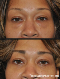 <strong>Procedures: Lower Blepharoplasty - Fat removal</strong> Procedures: Lower Blepharoplasty - Fat removal