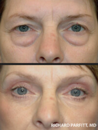 <strong>Procedure: Upper & Lower Blepharoplasty</strong> Procedure: Upper & Lower Blepharoplasty