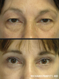 <strong>Procedure: Upper & Lower Blepharoplasty</strong> Procedure: Upper & Lower Blepharoplasty