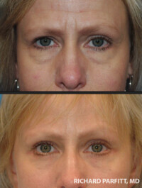 <strong>Procedures: Lower Blepharoplasty - Fat removal & tightening and Forehead Brow Lift</strong> Procedures: Lower Blepharoplasty - Fat removal & tightening and Forehead Brow Lift