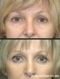 <strong>Procedures: Upper and Lower Blepharoplasty</strong> Procedures: Upper and Lower Blepharoplasty Dr. Parfitt