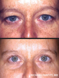 <strong>Procedures: Upper Blepharoplasty</strong> Upper Blepharoplasty - hooding