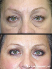 <strong>Procedure: Upper & Lower Blepharoplasty</strong> Upper and Lower Blepharoplasty tightening and fat removal