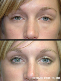 <strong>Procedure: Lower Blepharoplasty - Fat Removal</strong> Procedure: Lower Blepharoplasty - Fat Removal by Dr. Parfitt