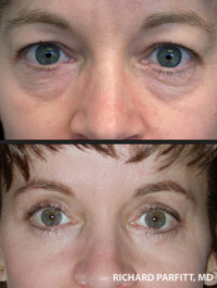 <strong>Procedures: Upper and Lower Blepharoplasty</strong> Procedures: Upper and Lower Blepharoplasty by Dr. Richard Parfitt