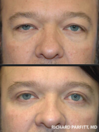 <strong>Procedures: Upper & Lower Blepharoplasty - male patient</strong> Upper Blepharoplasty to reduce hooding and Lower Blepharoplasty to remove bags