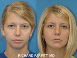 <strong>Procedure: </strong> Chin Implant & Buccal Fat Removal Before and After photo of young woman, Buccal Fat Removal, and Chin Augmentation, implant, by Dr. Richard Parfitt, Madison WI-Front view
