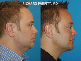 Procedures: Chin Implant, Submental (Neck) Liposuction chin implant male before and after patient