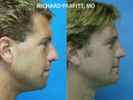 Procedures: Chin Implant, Rhinoplasty (Nose Job) plastic surgery chin implant male before and after