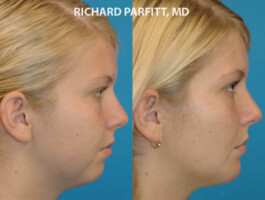 Procedure: Chin Implant Madison plastic surgery chin implant side view before and after