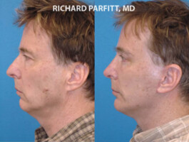Procedures: Chin Implant, Rhinoplasty (Nose Job), Facelift, Blepharoplasty (Eyelid Surgery) chin augmentation nose job Wisconsin plastic surgery