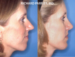 Procedure: Chin Implant chin implant WI before and after case