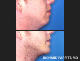 Procedure: Chin Implant chin implant male plastic surgery WI