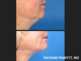 Procedure: Chin Implant chin augmentation before and after patient side view Appleton WI