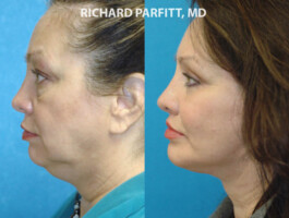Procedures: Chin Implant, Submental (Neck) Liposuction Appleton Wisconsin chin augmentation before and after side view