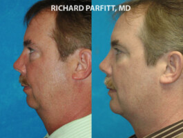 Procedures: Chin Implant, Submental (Neck) Liposuction chin augmentation side view male plastic surgery