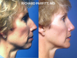 Procedure: Chin Implant Milwaukee chin implant face surgery before and after