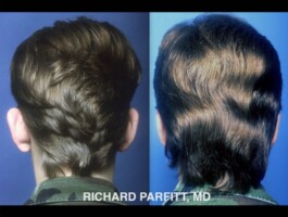 Male Otoplasty patient: Ear pinning by Dr. Richard Parfitt Madison, WI Otoplasty-ear-surgery-Middleton-WI-Richard-Parfitt-Male-Plastic-Surgery