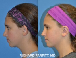 <strong>Procedure: </strong>Otoplasty Before and after picture, side view, young female, ear pinning, Otoplasty (ear-surgery) surgeon is Dr. Richard Parfitt of Madison WI