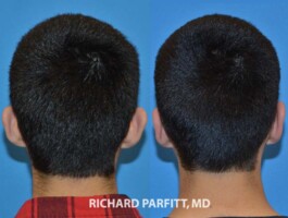 Male Otoplasty patient: Ear pinning back view by Dr. Richard Parfitt Madison, WI Otoplasty-ear-surgery-Appleton-back-WI-Richard-Parfitt-Male-Plastic-Surgery
