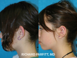 Middleton WI before and after otoplasty(Ear surgery)
