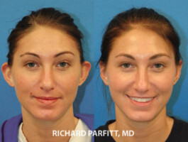Procedure Performed: Otoplasty (Ear Surgery) Ear surgery before and after images