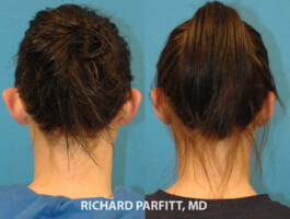 <strong>Procedure: </strong>Otoplasty Otoplasty- back view, before and after photos, Dr. Richard Parfitt, Middleton WI