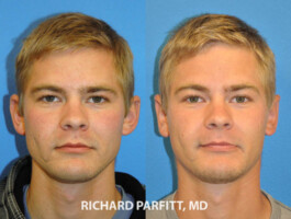 <strong>Procedure: </strong>Otoplasty otoplasty Appleton WI male before and after Richard Parfitt, MD