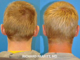 Otoplasty-ear-surgery-Middleton-WI-Richard-Parfitt-close up ear Otoplasty-ear-surgery-Middleton-WI-Richard-Parfitt, before and after images