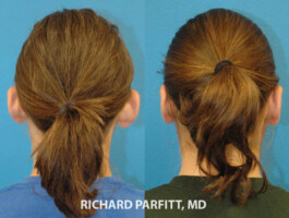 Procedure Performed: Otoplasty (Ear Surgery) Otoplasty-ear-surgery-Middleton-WI-Richard-Parfitt