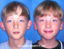 <strong>Procedure: </strong>Otoplasty Otoplasty-ear-surgery-Middleton-WI- Dr.Richard Parfitt-Male-Plastic-Surgery