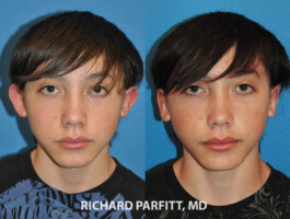 <strong>Procedure: </strong>Otoplasty Madison WI before and after ear surgery- Male- Otoplasty