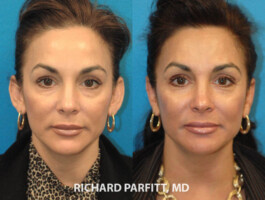 Procedure: Otoplasty (Ear Surgery) Madison WI female ear surgery