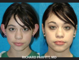 Procedure Performed: Otoplasty (Ear Surgery) Before and after photos- ear surgery