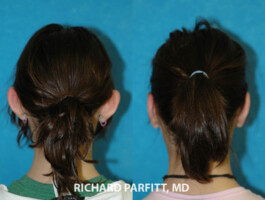 <strong>Procedure: </strong>Otoplasty Madison WI ear surgery before and after