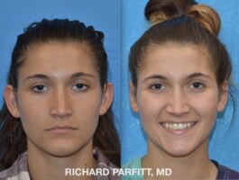 Procedure Performed: Otoplasty (Ear Surgery) Otoplasty-ear-surgery-Middleton-WI-Richard-Parfitt